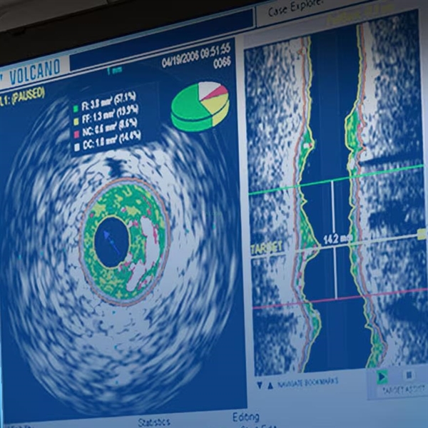 Resim IVUS